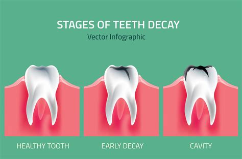 Advanced Tips for Tooth Decay Prevention You Need to Know Now