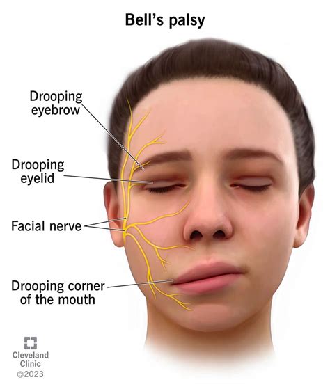 Understanding The Lasting Effects Of Bell's Palsy On Social Confidence