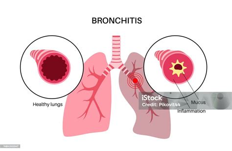 What To Expect After Acute Bronchitis Improves: The Lingering After Effects