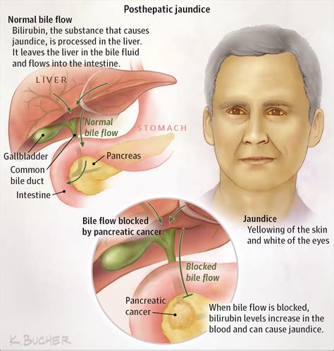 What To Expect After Recovering From Jaundice In Adults