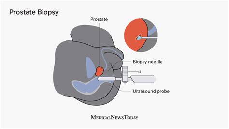 Understanding The After Effects Of Prostate Biopsy To Ease Your Mind