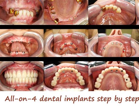All on 4 Dental Implants Australia: Transformative Smiles