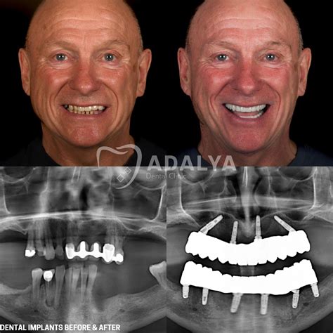 All on 4 Dental Implants: Stunning Before-After Results