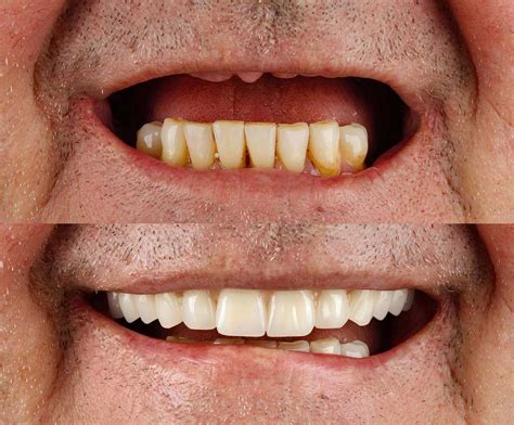 Affordable All on 4 Dental Implants in UK