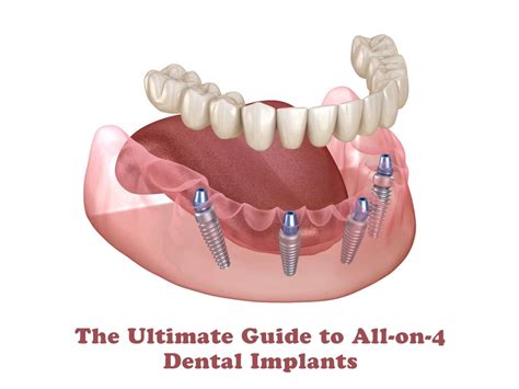 All-on-4 Dental Implants Payment Plan: Your Affordable Smile Solution