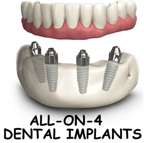 All on 4 Dental Implants Price: Budget Breakthrough