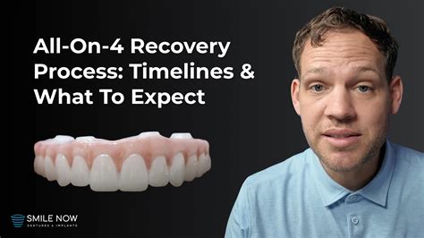 All on 4 Dental Implants Recovery Time Unveiled: Your Expert Guide