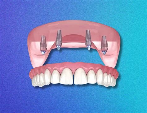 All on 4 Dental Implants Toronto: Top Solution Revealed