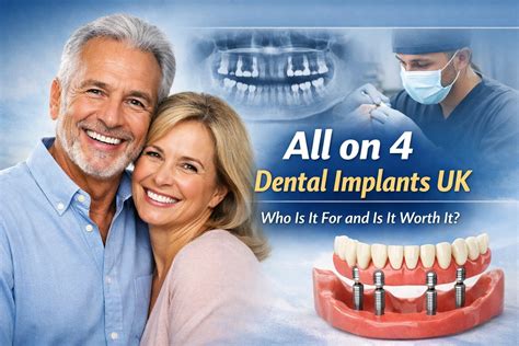 Best All on 4 Dental Implants UK Offer