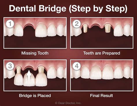 Top-Rated Dental Bridge Treatment in Dubai: Your Smile Makeover Awaits