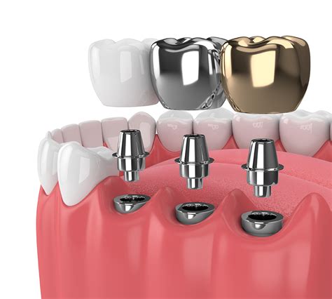 Discover Top-Rated Best Dental Implants in Australia Today