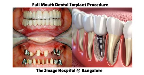 Best Full Mouth Dental Implants in Toronto Revealed