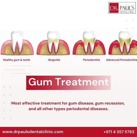 Top-Rated Best Gum Disease Treatment in Dubai Unveiled