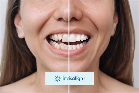 Discover the Best Invisalign Treatment in Singapore Today