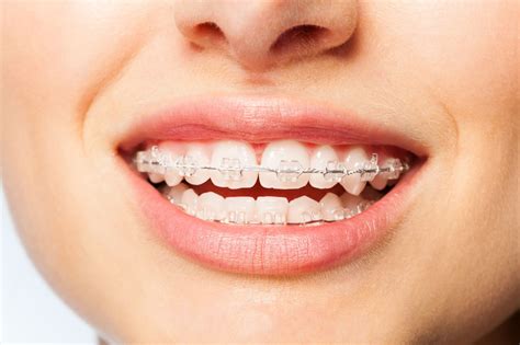 Top New York Invisible Braces Choices
