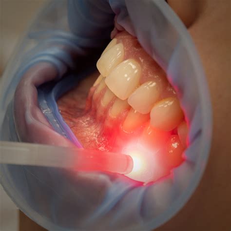 Top-Rated Laser Dentistry in Toronto Revealed