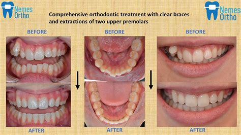 Top UK Orthodontic Treatment Secrets Revealed!