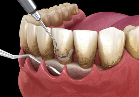 Top Periodontal Treatment in Los Angeles Revealed