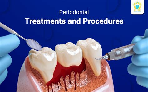 Top Choices for Best Periodontal Treatment in Toronto