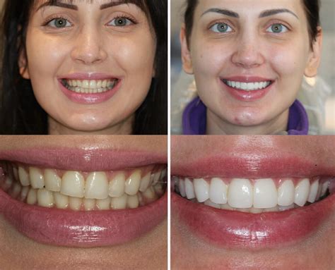 Top London Porcelain Veneers Revealed!