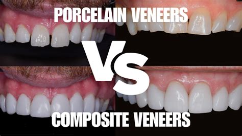 Top Porcelain Veneers in Singapore Revealed!