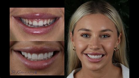 Top Smile Makeover Clinics in Australia Revealed