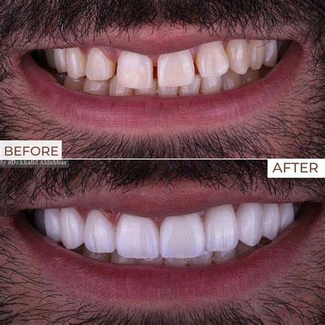 Discover Dubais Best Smile Makeover Experts Today
