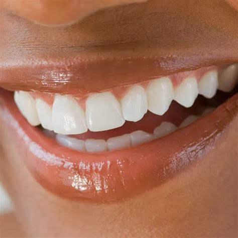 Top Choices for Best Teeth Whitening Treatment in Dubai