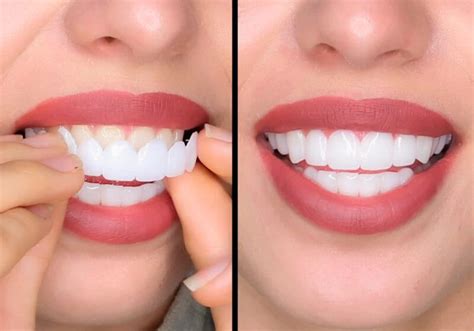 Top Choices for Best Veneers for Teeth in Canada Revealed