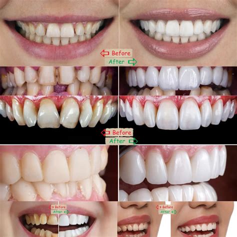 Top Veneers for New York Teeth in 2023