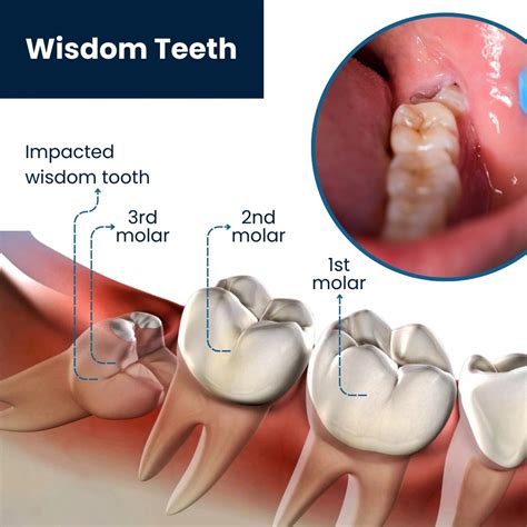 Top Tips for Best Wisdom Tooth Removal in Singapore