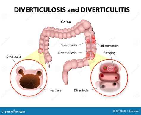 Understanding The Biology Of Diverticulosis Inside Your Gut