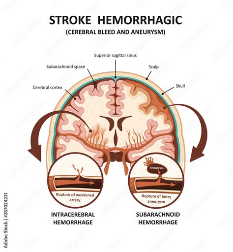 Bleed On The Brain Vs Stroke Spotting The Difference Between Aneurysms And Hemorrhage