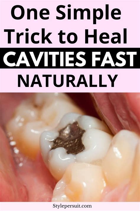 Cavity Prevention Home Remedies You Need to Try Now