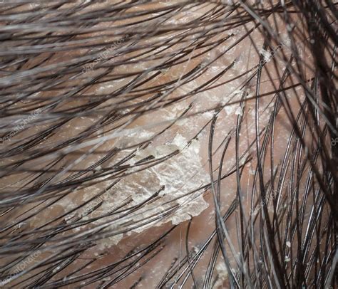 Close Up Of Dandruff: Causes And Solutions You Need To See