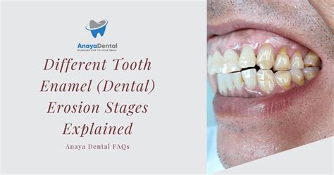 Enamel Care: Uncover Common Pitfalls Now