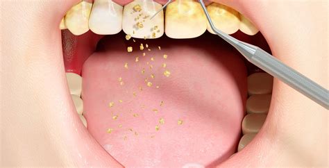 Common Problems with Tartar Removal Unveiled: What You Should Know