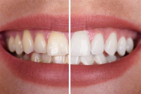 Revealing common problems with teeth whitening