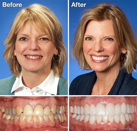 Cosmetic Dentistry Before and After: Real Transformations
