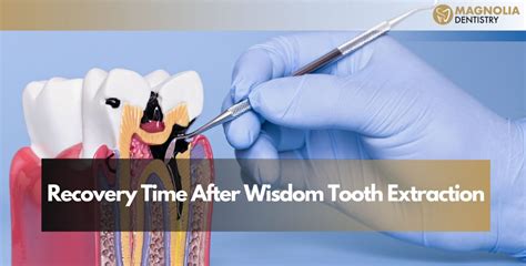 Cosmetic Dentistry Recovery Time Uncovered