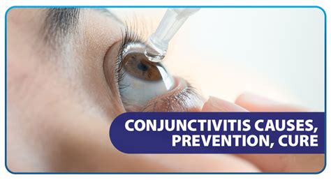 Is Pink Eye Contagious How To Cure It At Home