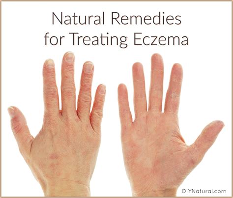 The Real Cure For Eczema: A Dermatologist Explains