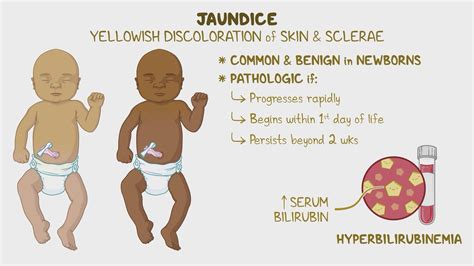 The Best Natural Cure For Jaundice To Speed Up Recovery