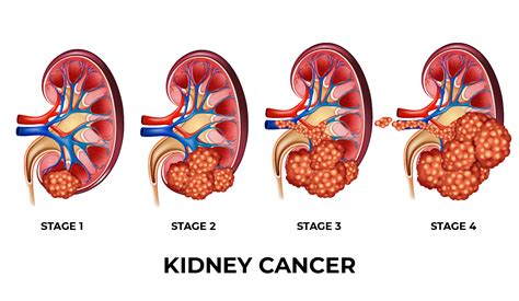 Is There A Cure For Kidney Cancer? What Experts Know Now