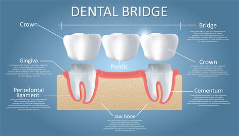 Dental Bridge Treatment Benefits: Restore Your Smile Today!