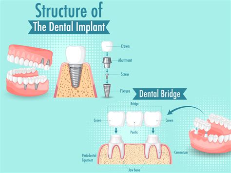 Los Angeles Dental Bridge Treatment Cost Insights