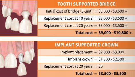 Dental Bridge Treatment Cost in Toronto: Affordable Smiles Revealed