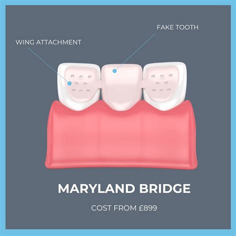 Uncover Dental Bridge Treatment Cost in UK: What You Need to Know