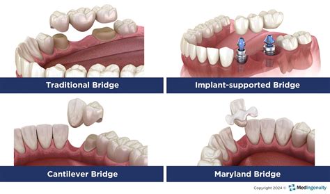 Dental Bridge Treatment Procedure Explained Simply and Professionally