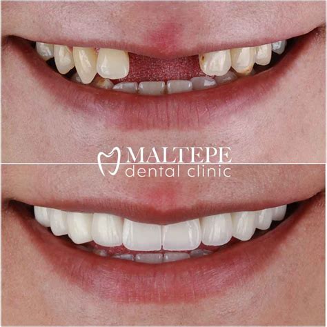 Discover Amazing Dental Bridge Treatment Results